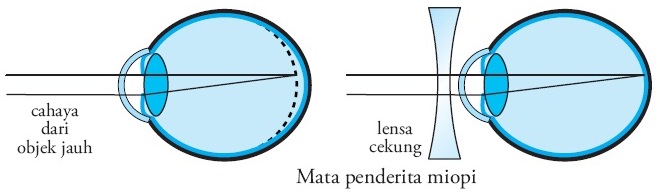 Astigmatism hipermetropic