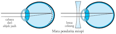 mata penderita miopi mata penderita miopi