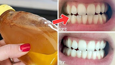 Gargle With One Simple Ingredient And See What Happens To Your Teeth Gargle With One Simple Ingredient And See What Happens To Your Teeth