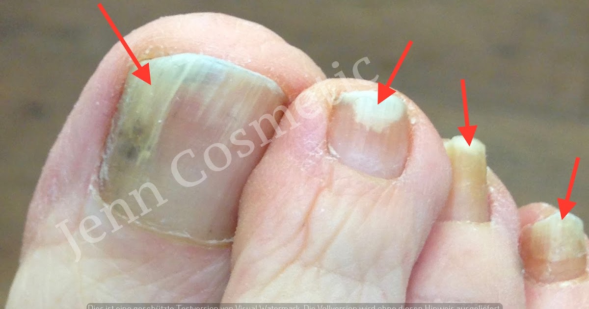 Fußnagelpilz. Nagelpilz behandeln. Jenn Cosmetic Nagelveränderungen. Jenn Cosmetic.