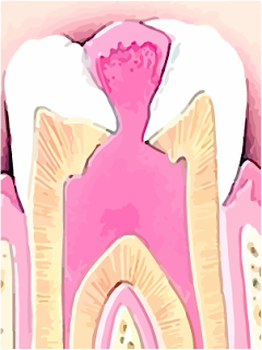 pulp polyps