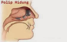 Obat Polip Hidung Tradisional