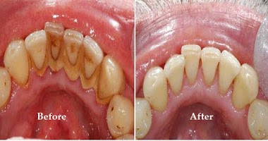 How to Remove Teeth Plaque At Home, Tips to Control Tartar