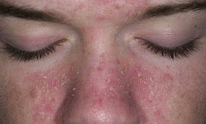 egzama icin en iyi tedavi herbalist