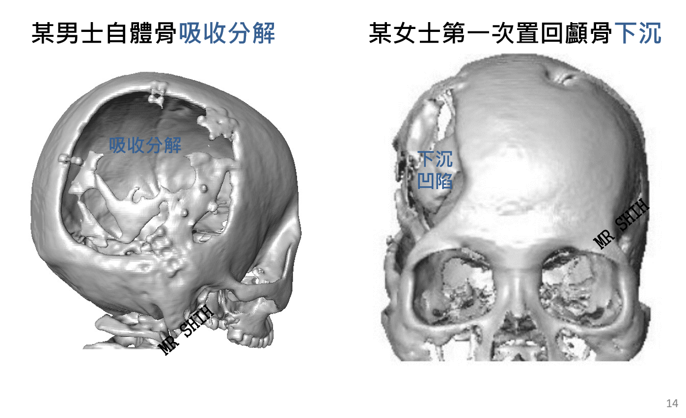 Mr Shih 施育彤醫師 3d列印作的頭蓋骨