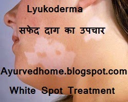 Safed Daag or White Spot Treatment