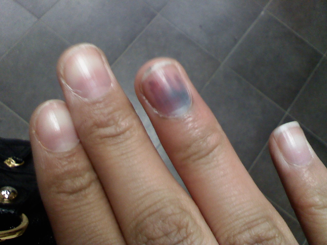 Fingernail Melanoma - Dermatology - MedHelp