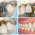 Vì sao nên trồng răng implant khi mất răng ?