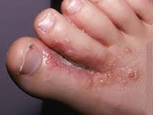 Cara mengobati penyakit eksim di sela jari kaki