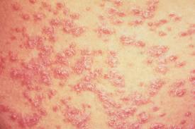 streptococcal skin rash