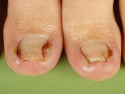 Ingrown toenail treatment: surgery Ingrown Toenail Treatment: Surgery - What Is An Ingrown oenail