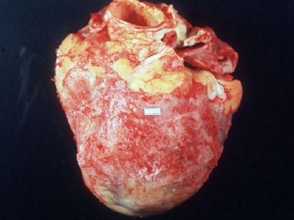 Pericardite Aguda - Inflamação nas Estruturas Cardíacas ...