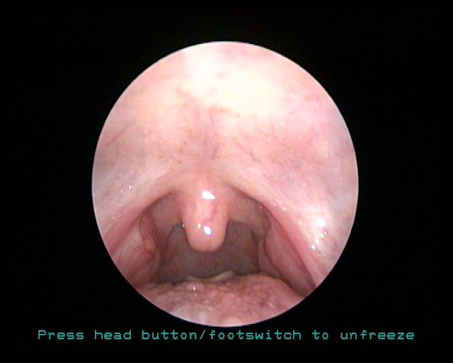 Pictures Of Normal Throat 26