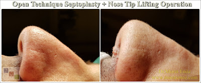 Open technique septoplasty in İstanbul - Nose tip lifting in İstanbul - Open tecnique septoplasty operation - Open technique nose tip plasty in İstanbul - Open technique nose tip lifting in Turkey - Nose tip drooping - Open technique nasal septum correction surgery - Septum deviation surgery - Treatment of nose tip droops - Treatment of nasal tip droop when smiling - Nose tip droops when smiling - Droopy nose tip surgery