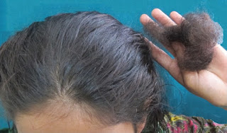 Jenis Kebotakan Stress Induced Alopecia 