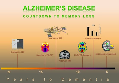 alzheimers timeline