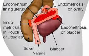 Endometriosis Sites