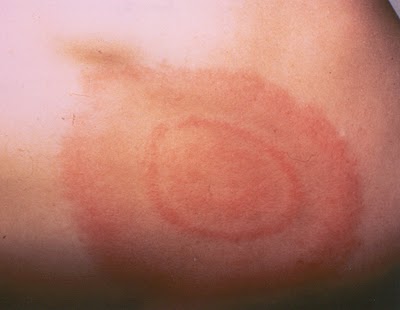 Erythematous Ring With White Center Erythematous Ring With White Center