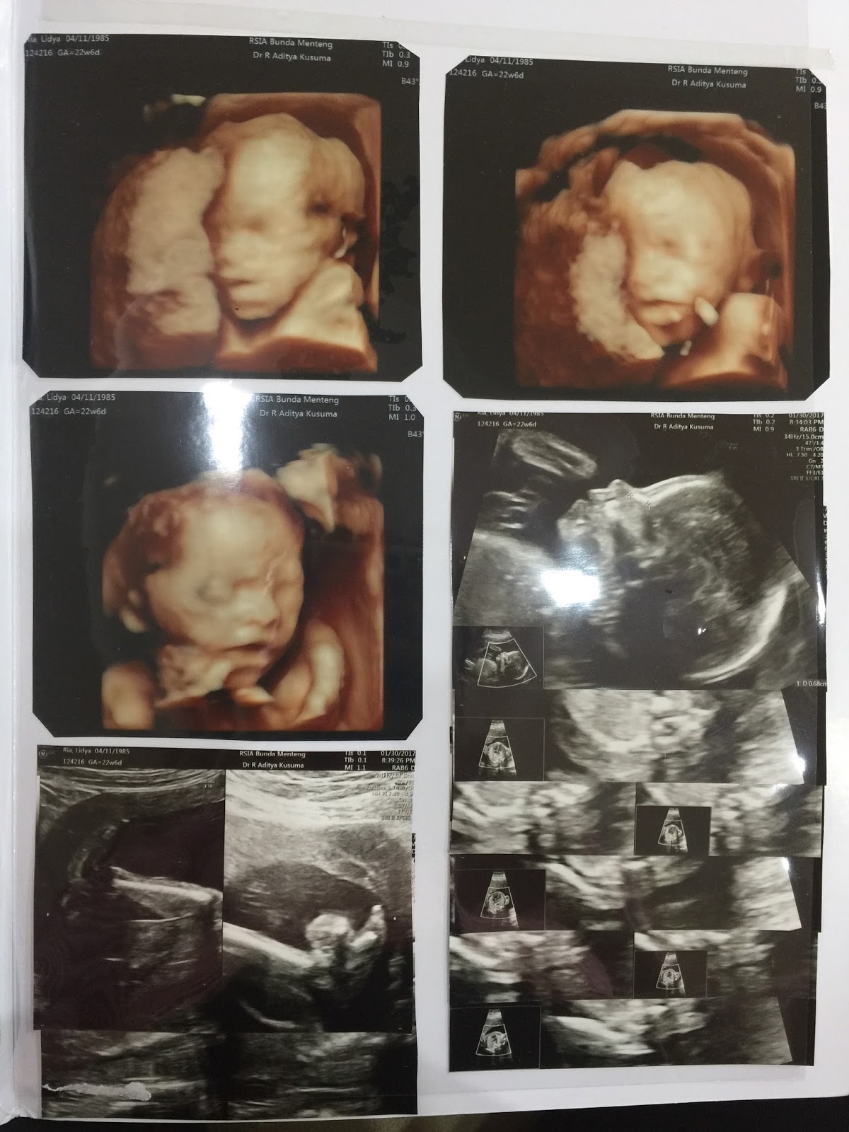 Berhasilnya penantian panjang melalui program bayi tabung (IVF): Jenis