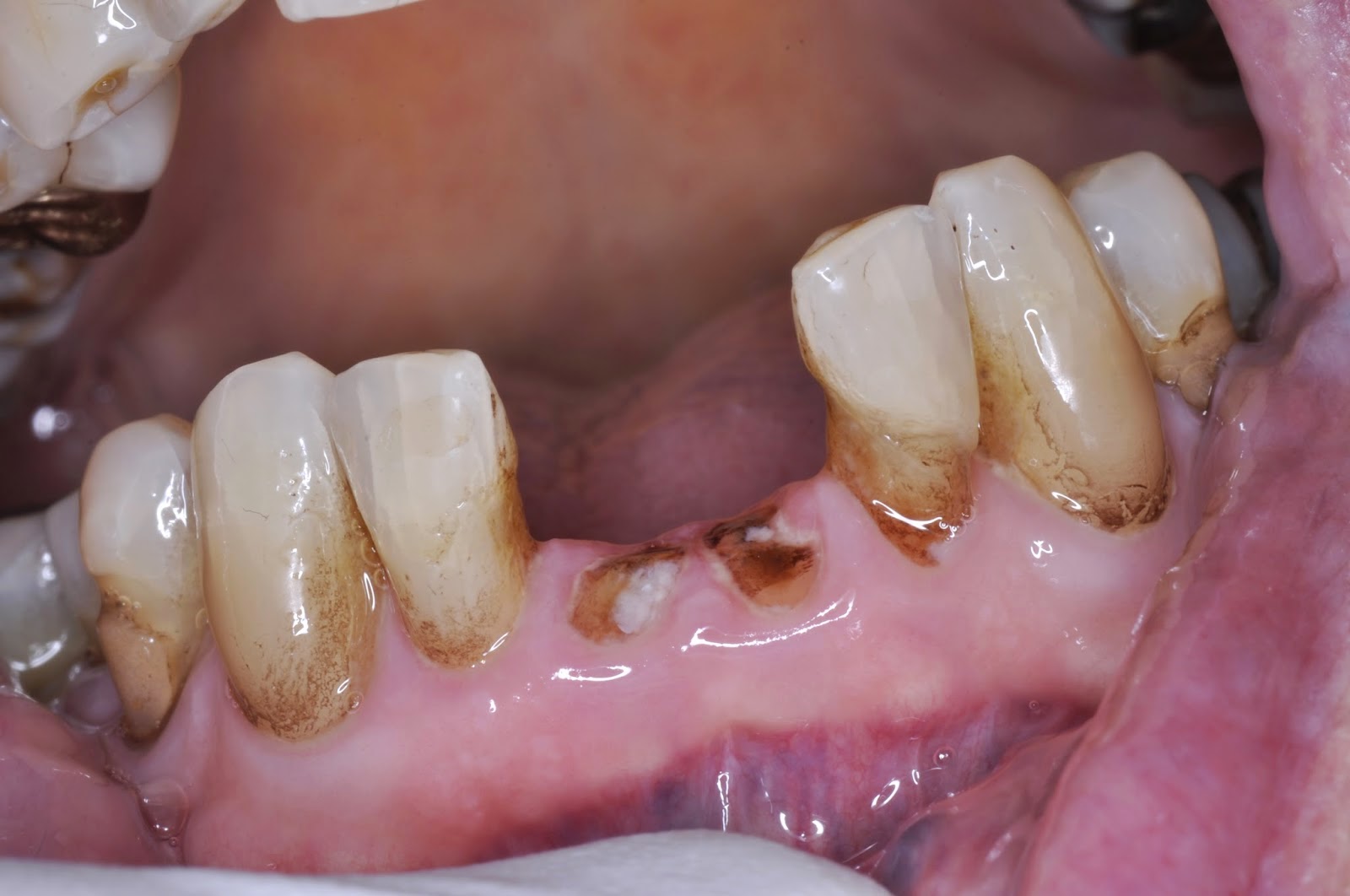 Ask Dr. Spindel Should a tooth thats broken to the gum line be fixed?