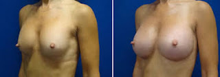 augmentation mammaire photo avant et après pour femme marié