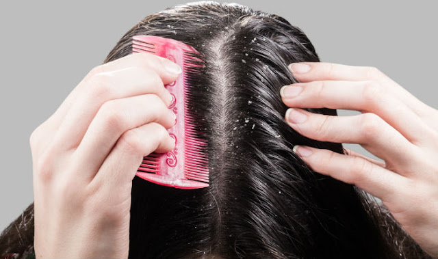 8 NATURAL WAYS TO REMOVE DANDRUFF 8 NATURAL WAYS TO REMOVE DANDRUFF