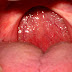 Uvulopalatopharyngoplasty