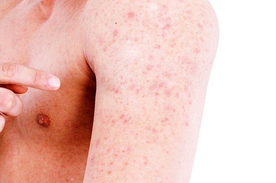 Como saber se é Psoríase ou Dermatite?