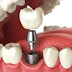 Implante Dentário em Madureira, Polo 1, Rio de Janeiro: Qual é o preço de um implante dentário?