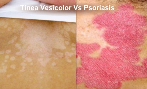What There is to Know About Psoriasis and Tinea Versicolor