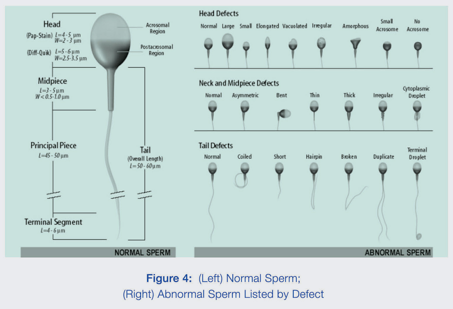 Нормальный сперматозоид (слева) и сперматозойды с дефектами (справа)