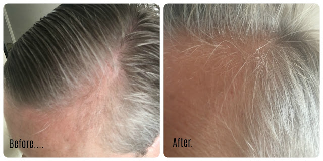 TRX2® food supplement & revitalising lotion Before & After pictures