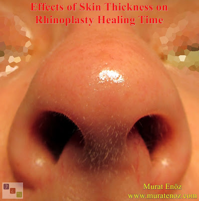 Skin Thickness - Rhinoplasty Healing Time - Thick Skin Causing Prolonged Swelling