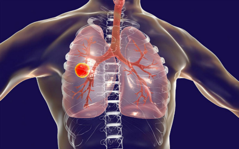 Tuberculosis Tuberculosis