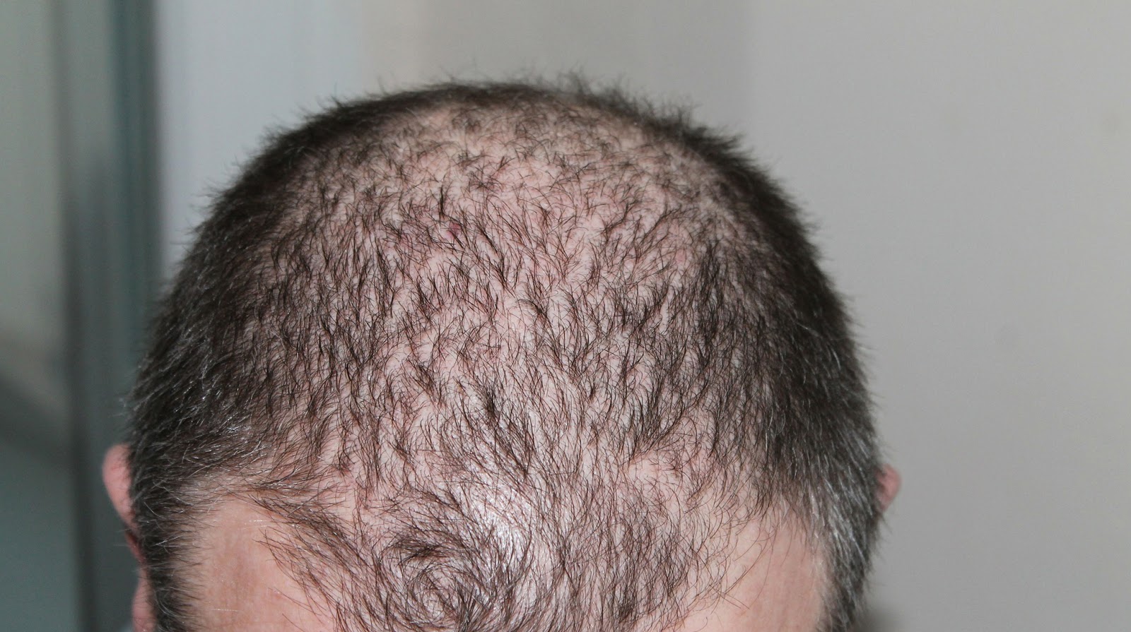 Parayil Mediaone 6 Natural Home Remedies For Hair Loss