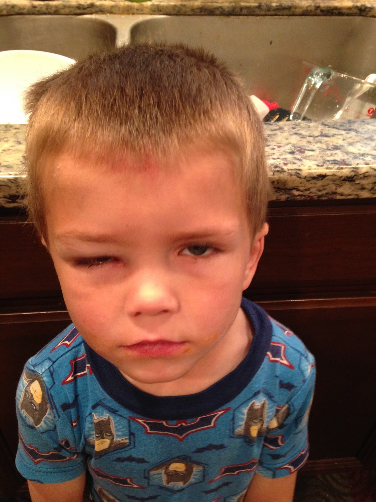 What Was I Thinking? Liam's black eye and we make ice cream