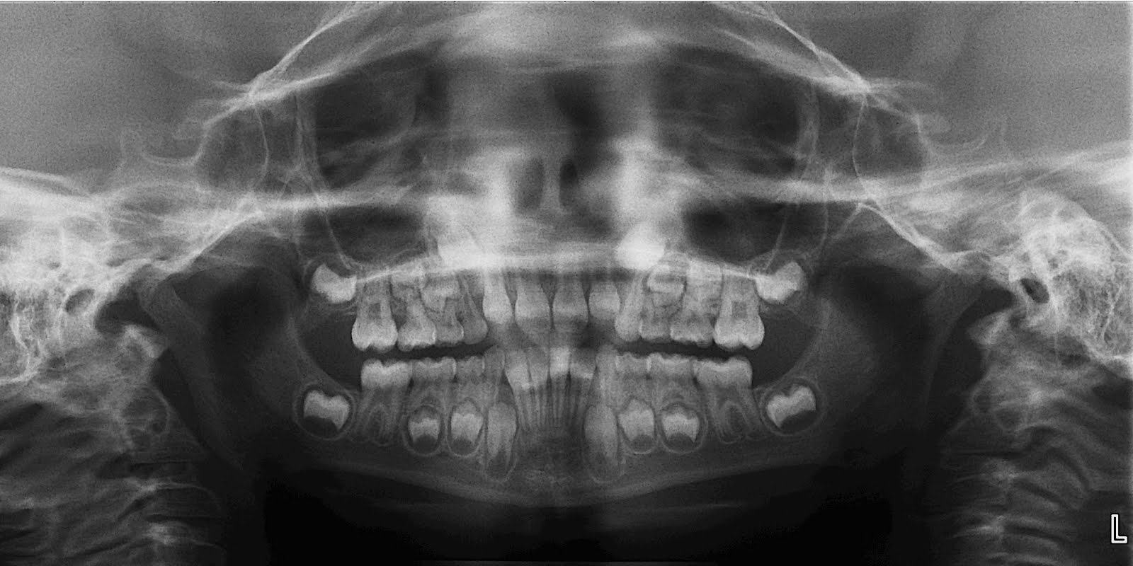 BiggsHansen Orthodontics Smiles Above the Rest Dental Radiograph