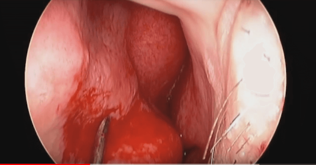 drainage-septal-hematoma