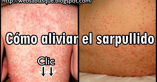 ¿Sabías que? : Cómo aliviar el sarpullido