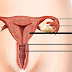 Bất ngờ với dấu hiệu của 6 bệnh về tử cung và buồng trứng thường gặp