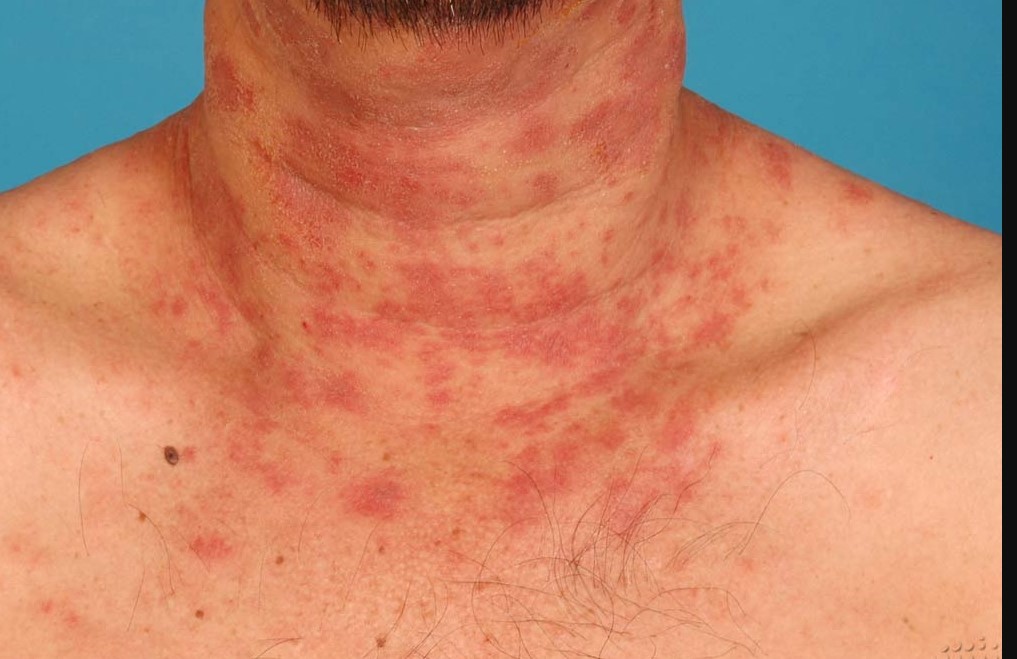 atopik dermatit nedir nedenleri