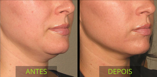 Vithara é uma nova geração de ultrassom microfocado - Geri e Derme Beauty