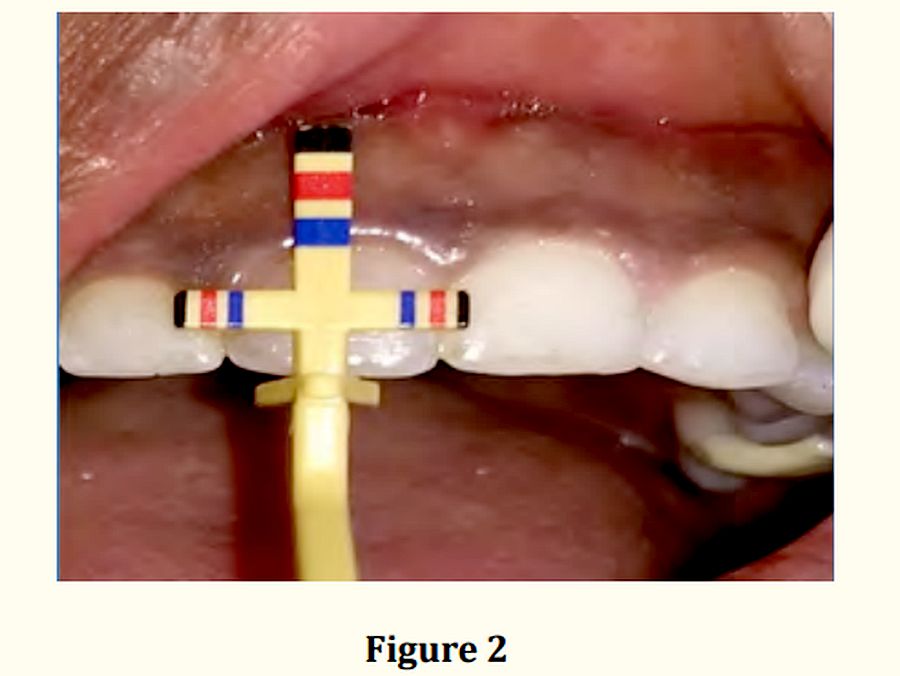 Gingival Hyperplasia Braces