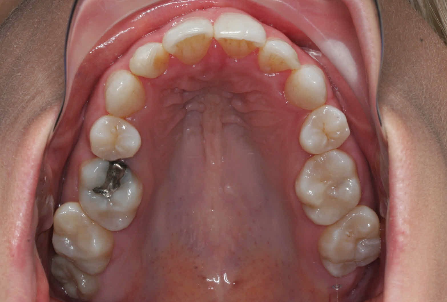 Acceledent Review Braces off 5 Months Early!