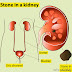 NATURAL TIPS AND REMEDIES FOR KIDNEY STONES