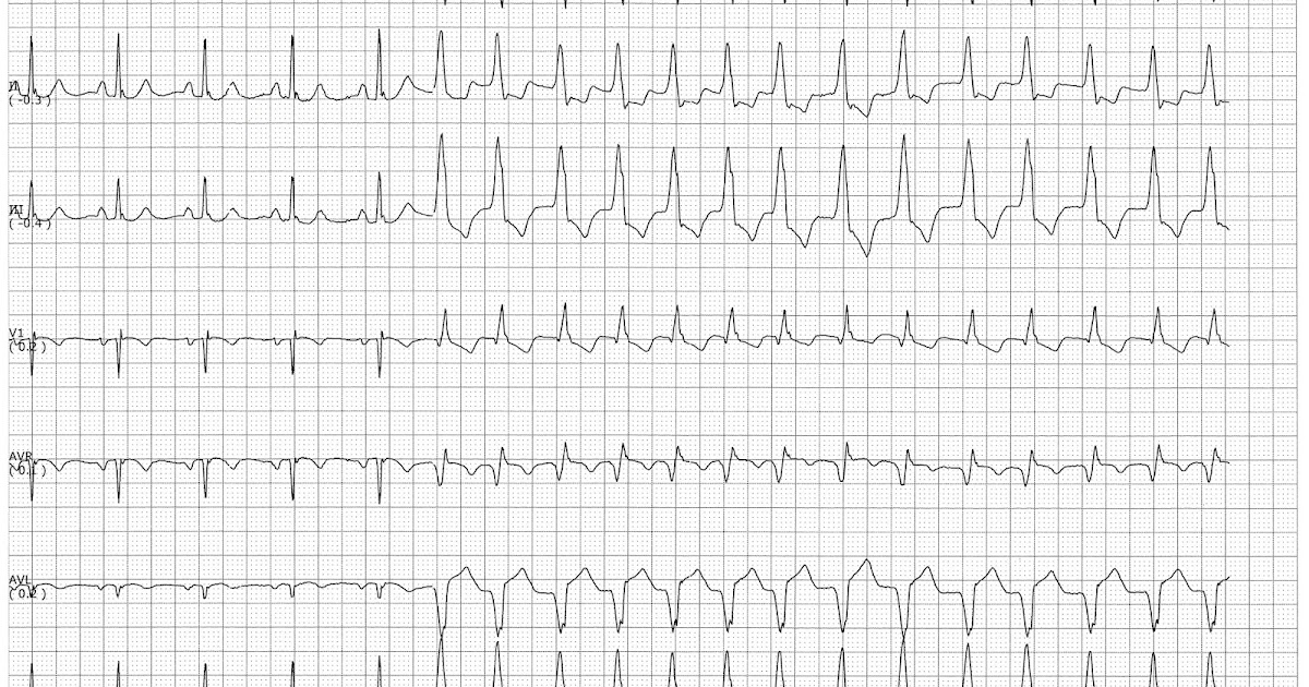 sinus rhythm ivcd sinus rhythm ivcd