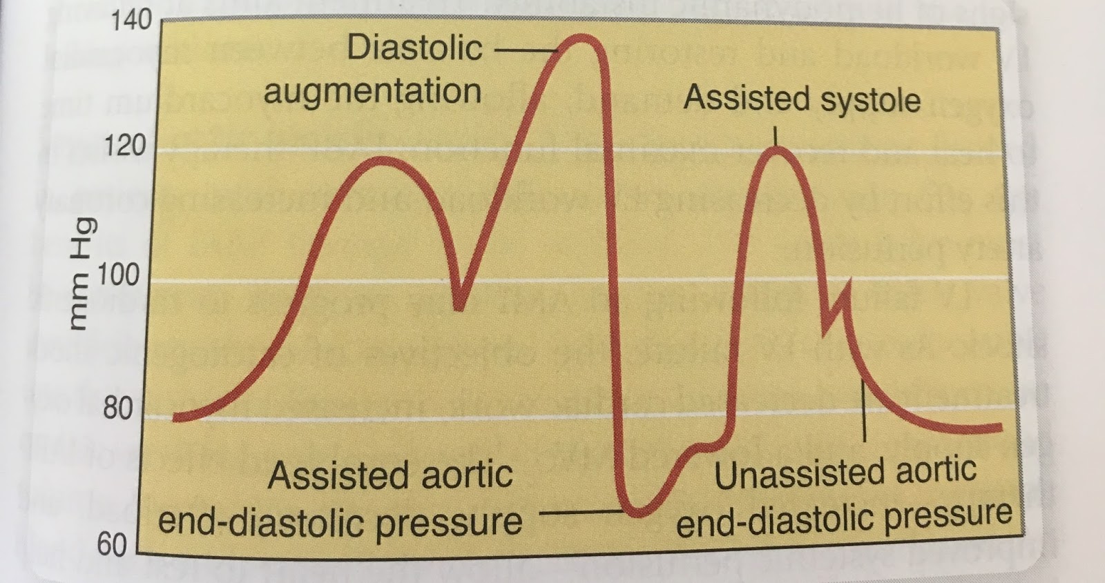 Forma de onda arterial en hipertensión sistémica significado de muesca dicrótica Forma de onda arterial en hipertensión sistémica significado de muesca dicrótica