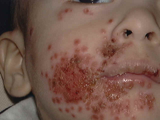 Neonatal Herpes Infection: A Review - Medscape