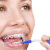 Phương pháp niềng răng nào giá rẻ nhất, bao nhiêu tiền?