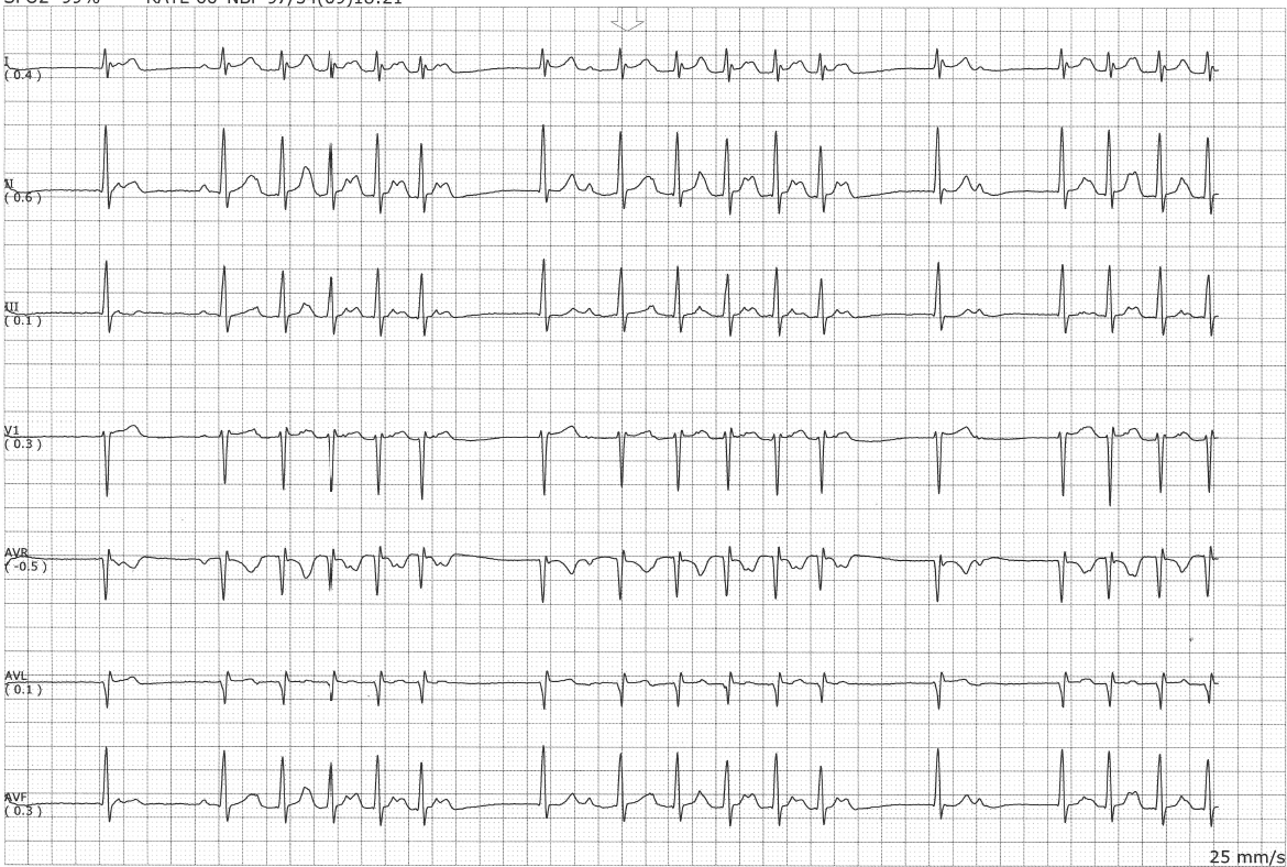 Practice EKG Strips